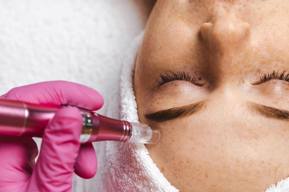 Microneedling con dermapen